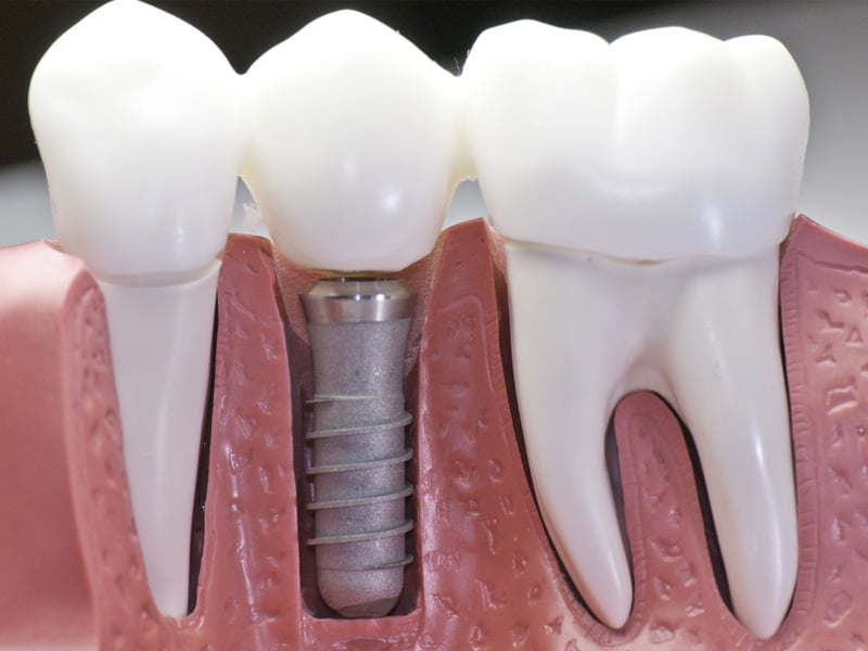 dental implants in townsville