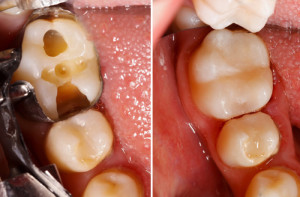 Composite Fillings in Deeragun Dental | Dentist in Townsville