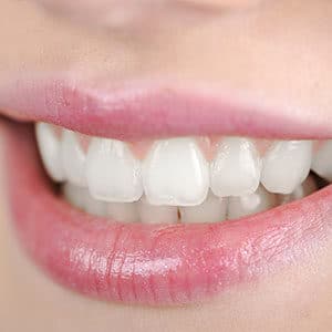 Image of white teeth after taking service of teeth whitening from Deeragun Dental