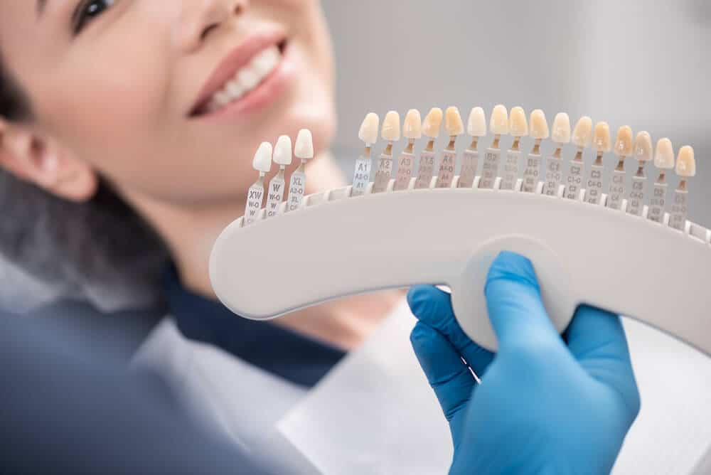 Are Porcelain Veneers Permanent? - Deeragun Dental