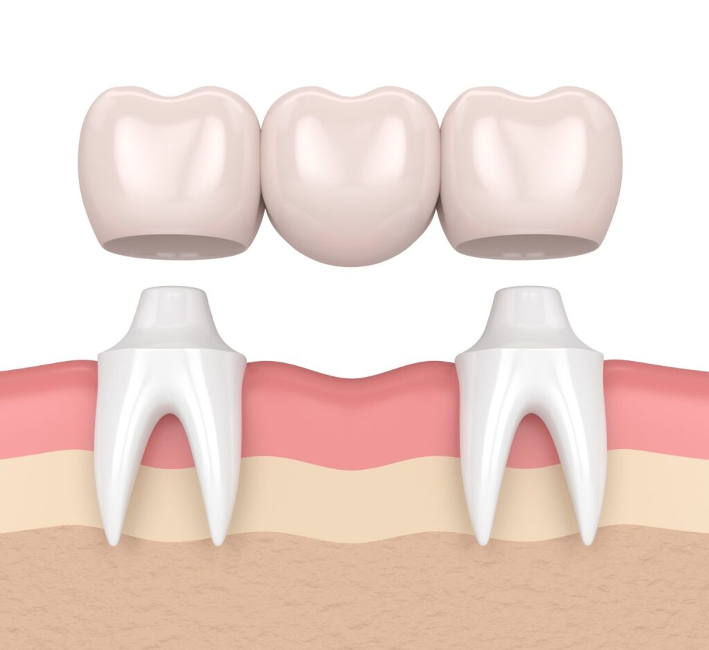 Dental bridge problems