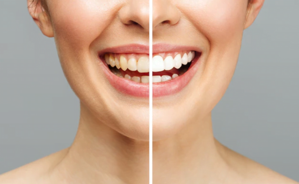 Before and After Teeth Whitening