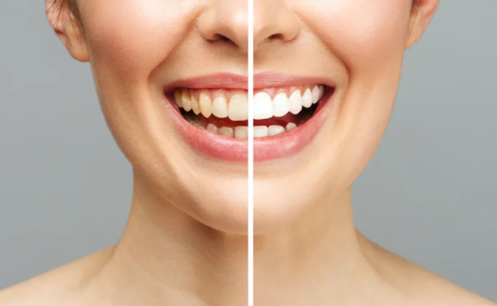 Before and After Teeth Whitening
