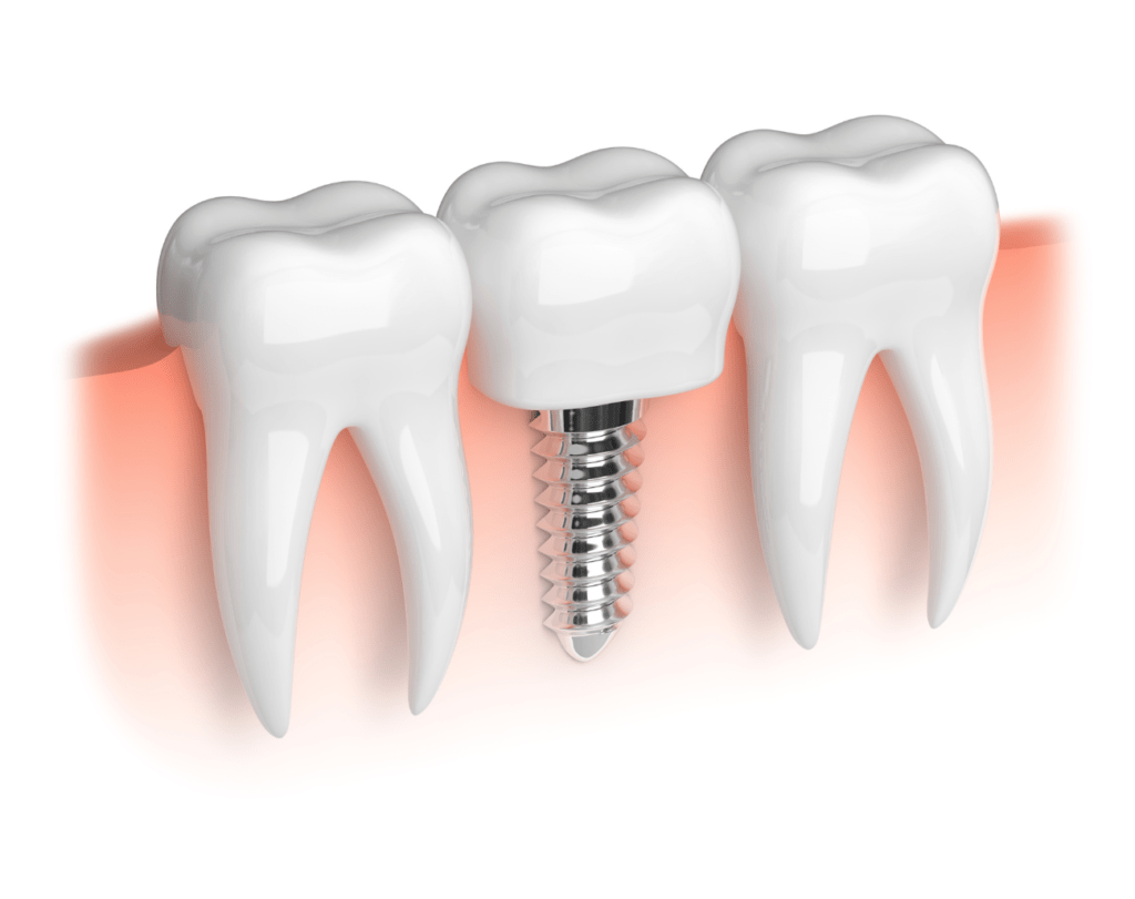 dental implants in Townsville