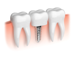 dental implants in Townsville