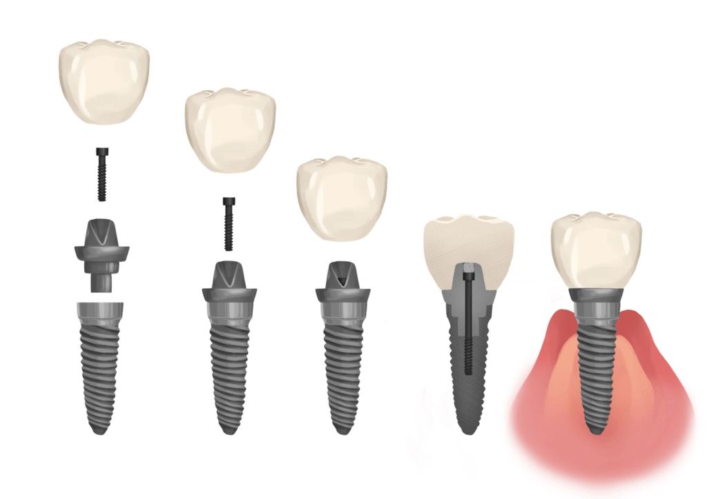 Dental Implants Deeragun, Townsville