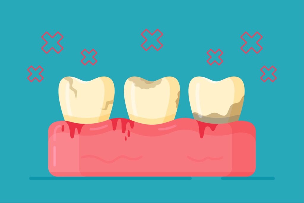 Bruxism - Deeragun Dental, Dentist in townsville