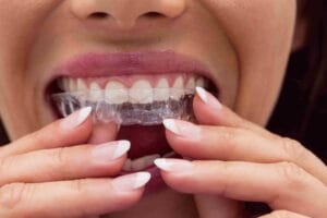 Custom Mouthguard Townsville